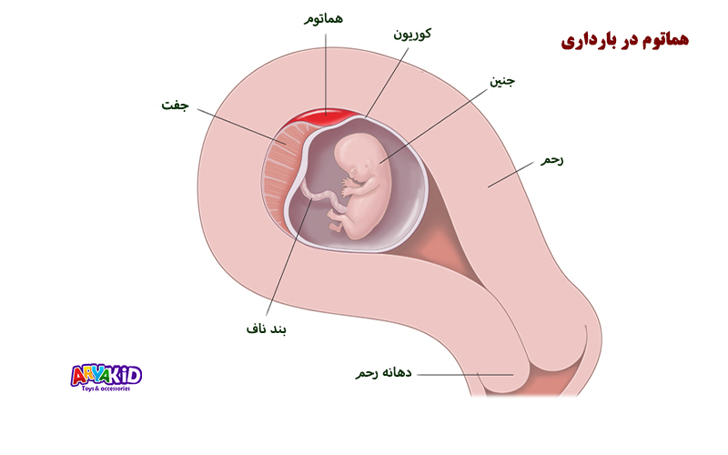 هماتوم در بارداری